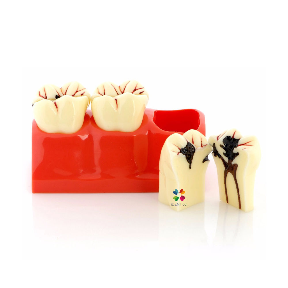 iDENTical Caries Development Tooth Model M4020 Online at Best Price ...